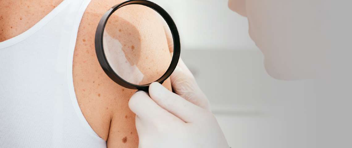 Estudos IMspire 150 e COMBI-i avaliam o papel da terapia tripla em melanoma avançado