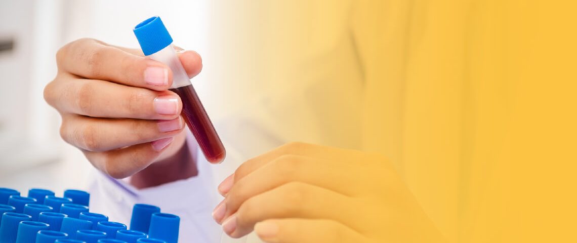 Las biopsias líquidas se utilizan para distinguir nódulos pulmonares malignos o benignos