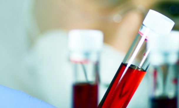 Linfoma não Hodgkin