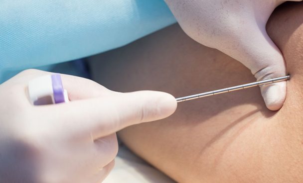 Mielograma – Biopsia de Médula Ósea