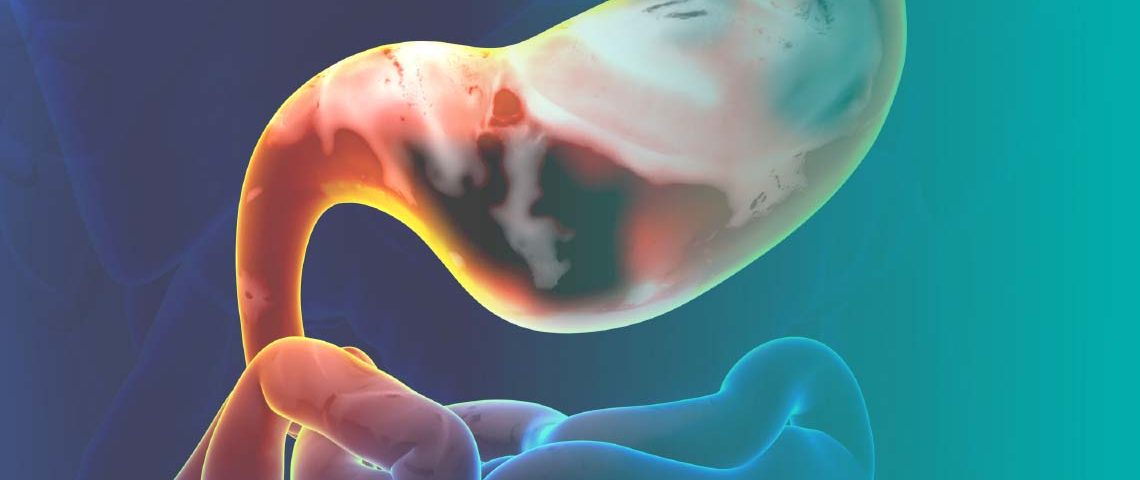 Nuevos datos de CheckMate 649 indican que agregar nivolumab a la quimioterapia para tratar la enfermedad avanzada metastásica o irresecable mejora el pronóstico