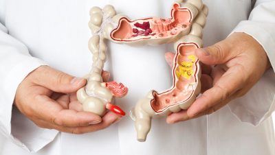 Entenda os fatores do risco do câncer colorretal