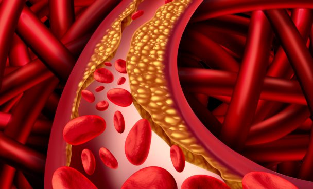 Entenda por que o colesterol alto pode ser um fator de risco para o câncer