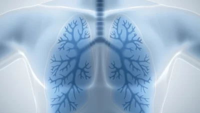 Germline Testing Recommendation (GTR) in Non Small Cell Lung Cancer (NSCLC) after Broad Tumor Sequencing