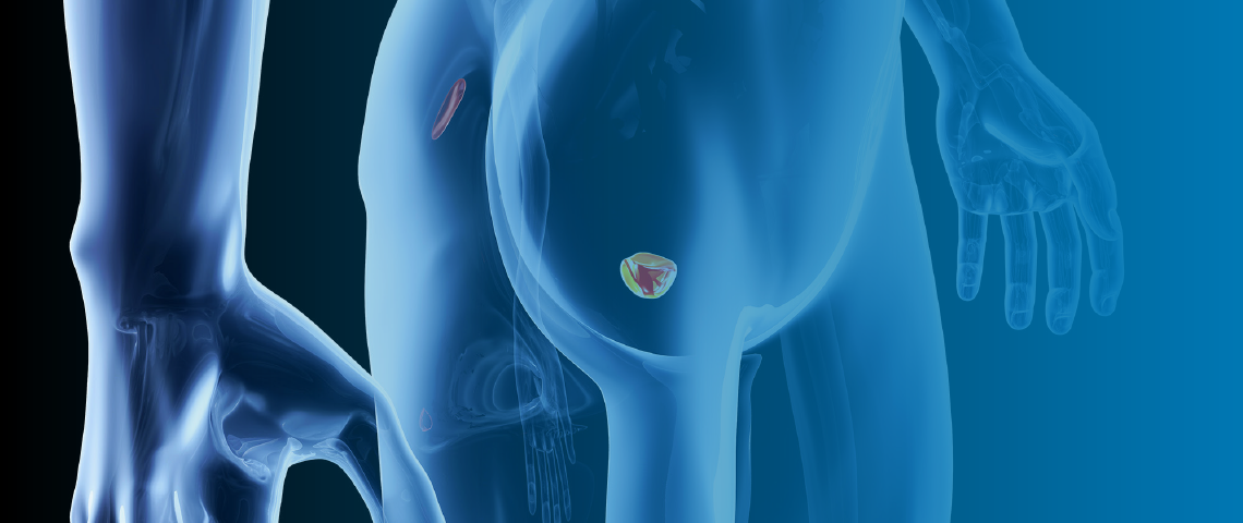 Estudio TheraP apunta resultados promisores con el radioligando 177Lu-PSMA-617 en cáncer de próstata metastásico resistente a la castración
