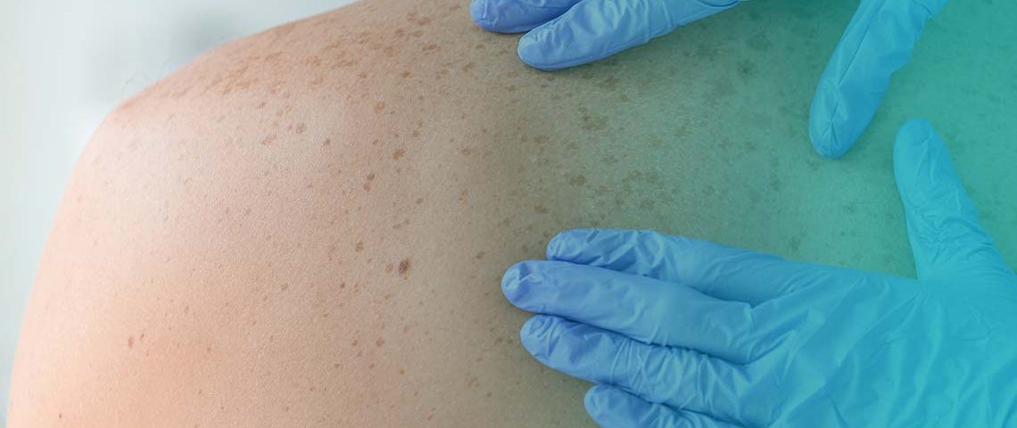El estudio EORTC 1325-MG/Keynote-054 afirma que pembrolizumab es una opción para el tratamiento adyuvante del melanoma